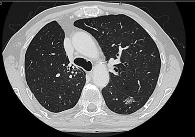 Awake uniportal VATS sublobar lung resections in high-comorbidity patients: Single-center early post-operative outcomes